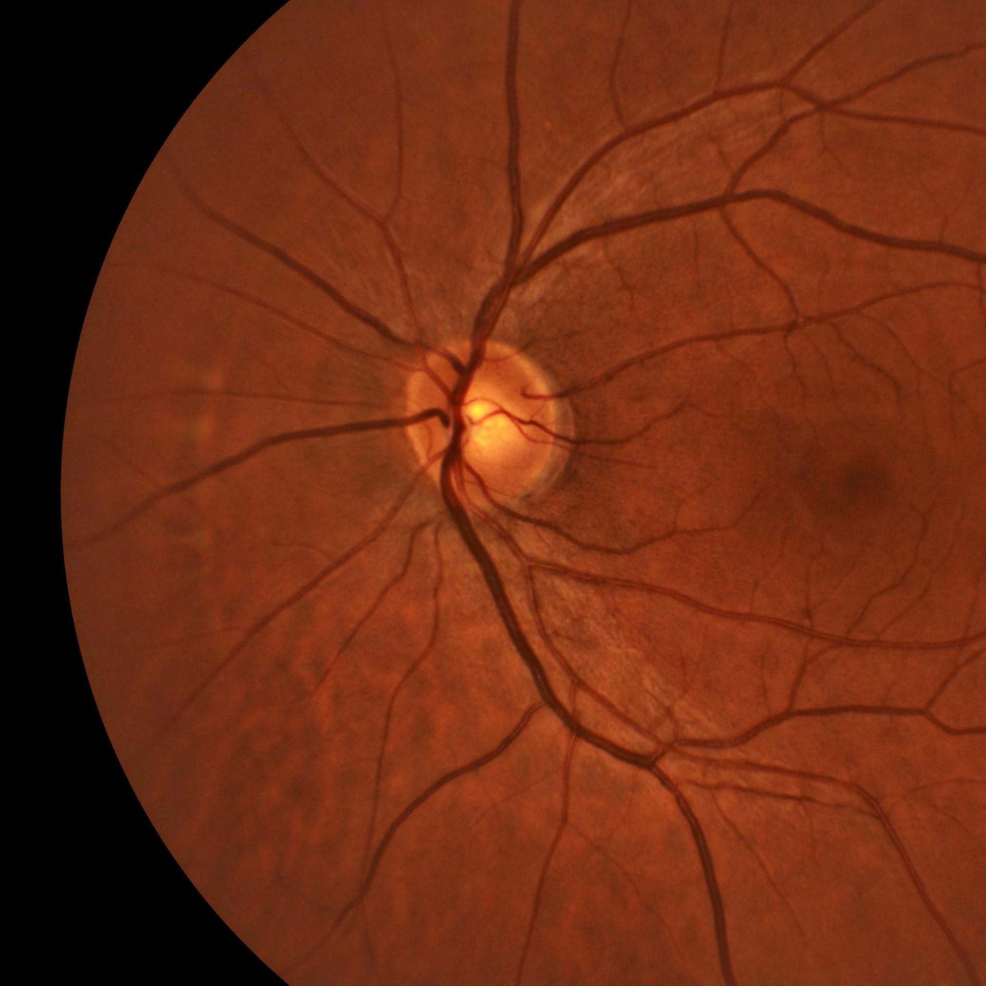 Posterior segment analysis.