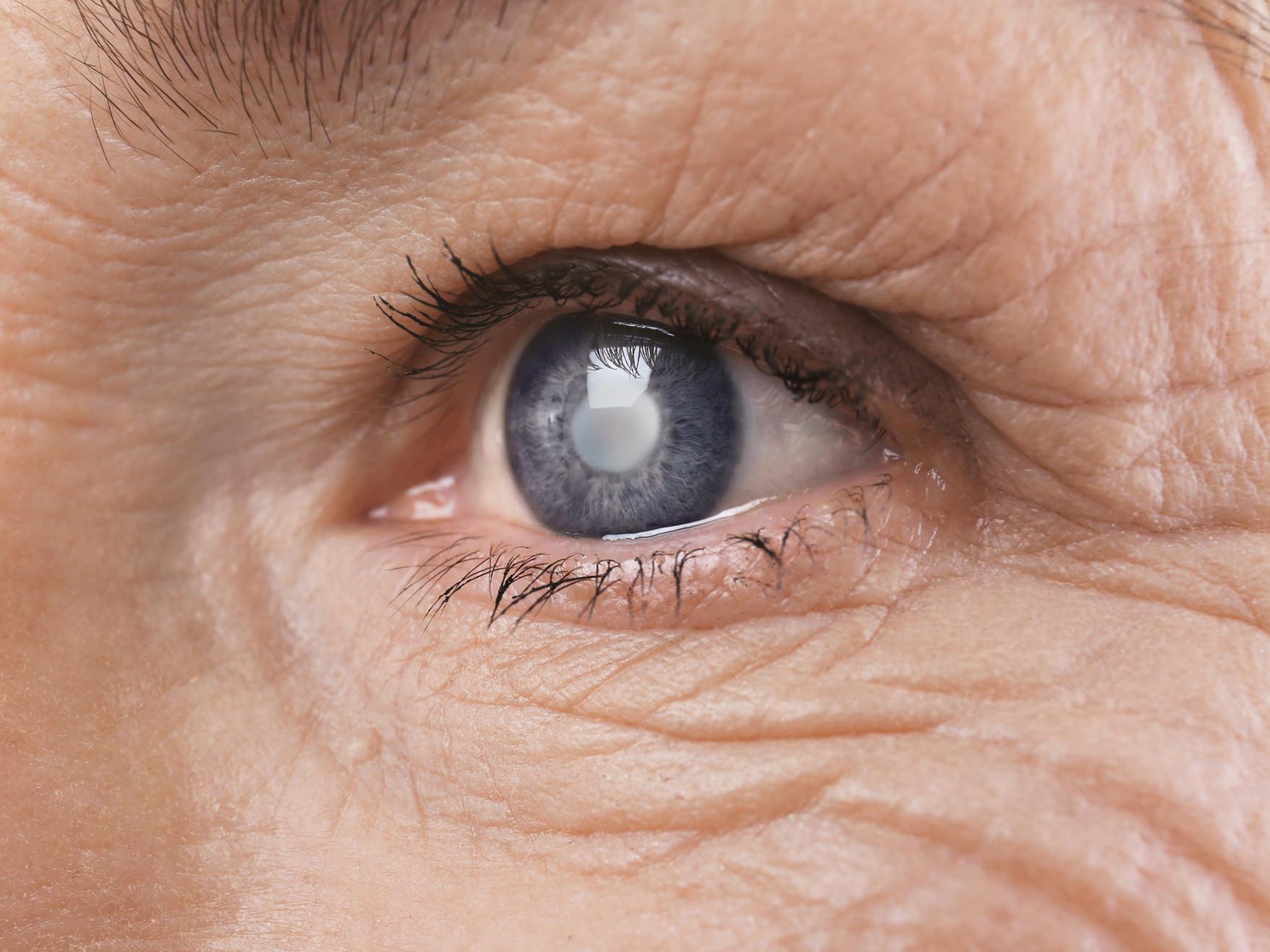 Image showing cataracts.