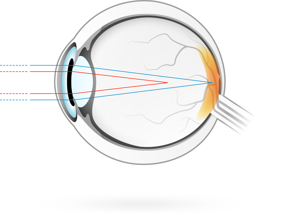 散光—得此症狀的角膜彎曲度不對稱，使得光線無法聚焦於一點，而是兩個點，因而引起視力模糊。