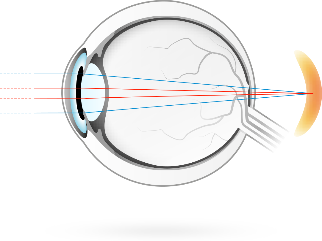 遠視—此症狀會使視覺圖像的聚焦位於視網膜的後方，而導致眼睛較難對焦於近距離物體