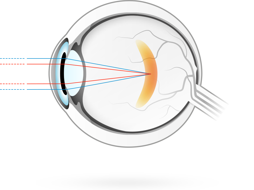 近視—此症狀會使視覺圖像的聚焦位於視網膜的前方，而引起遠距視力模糊