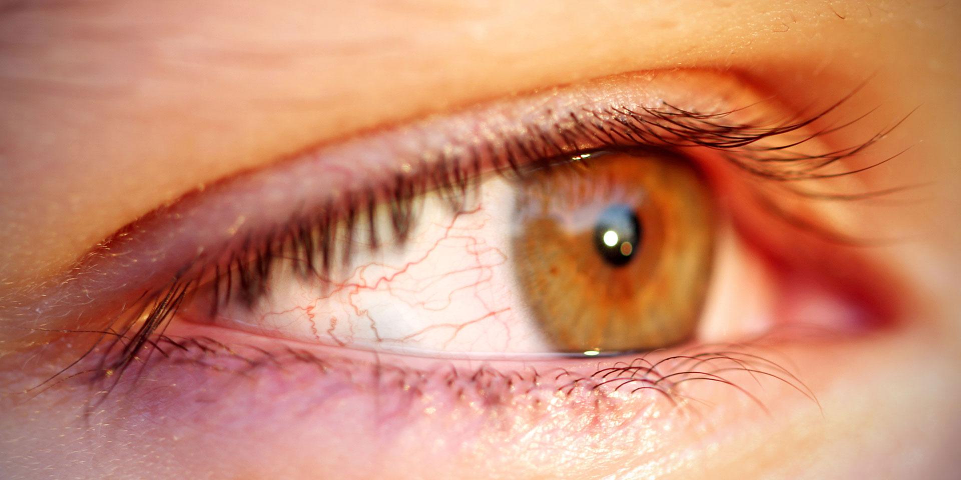 Red or sore eyes