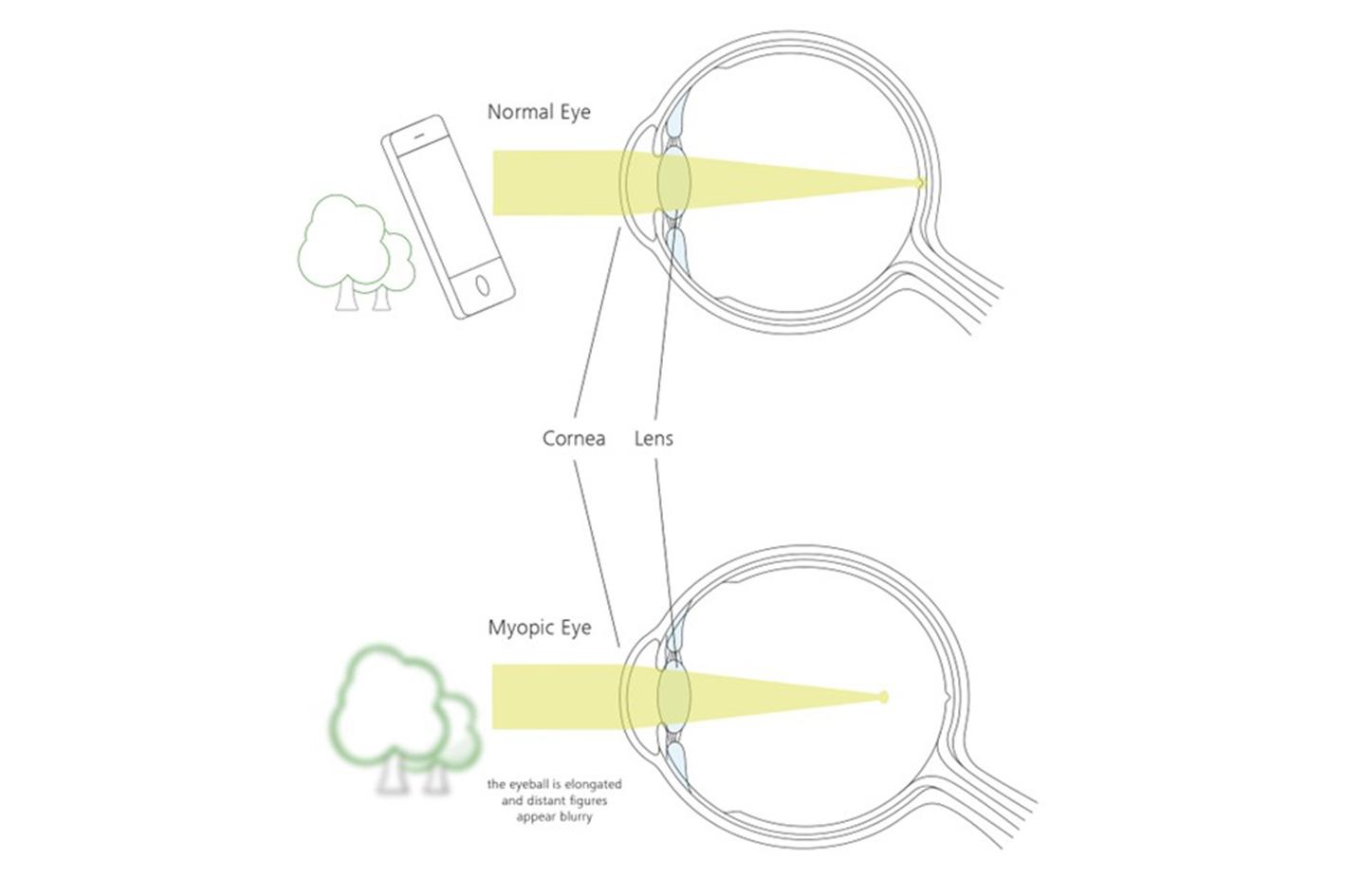 如果眼球過長，進入眼睛的光線會到達視網膜前方的焦點。