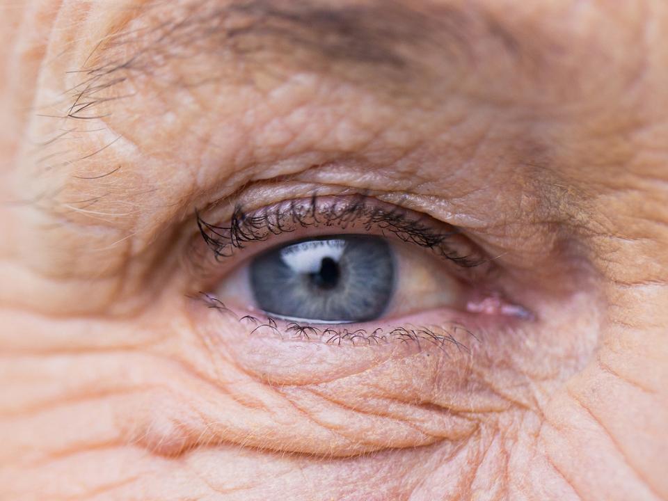 展示眼周皮膚光老化症狀的圖像