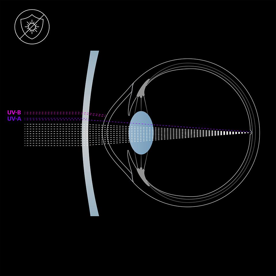 Illustration of the eye and a lens without UV protection, transmitting UVA and UVB light rays in the eye.  