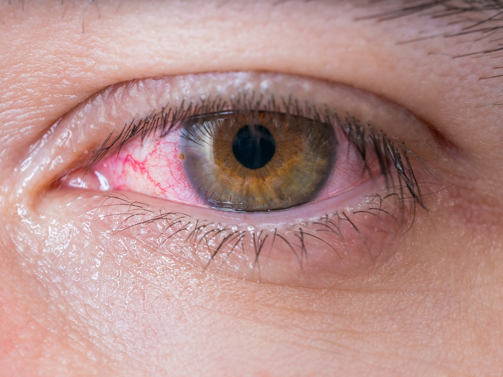 此圖為不健康眼睛的特寫，展示了潛在眼疾的外觀。 