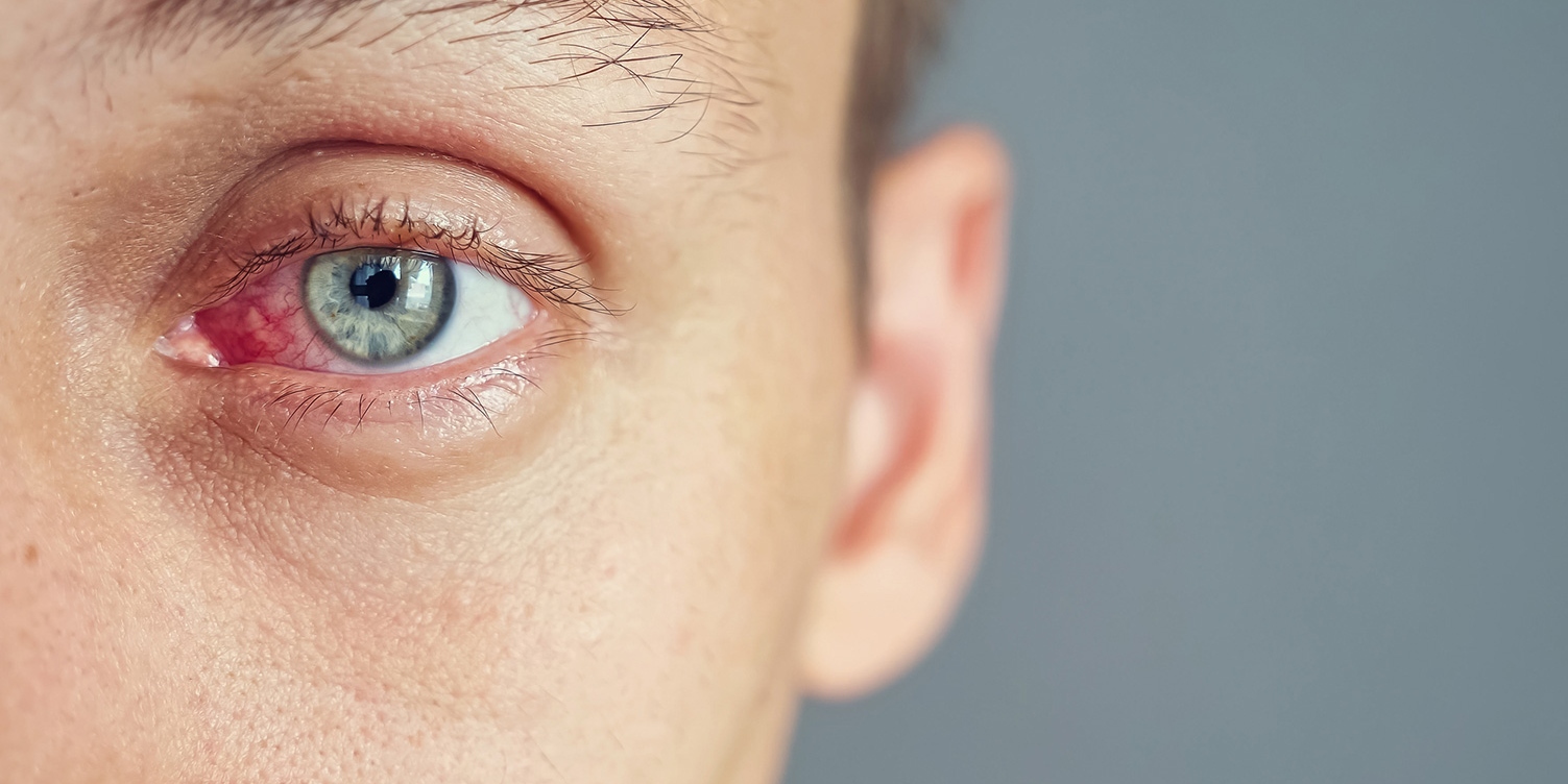 受感染、結膜炎影響的男性紅眼特寫