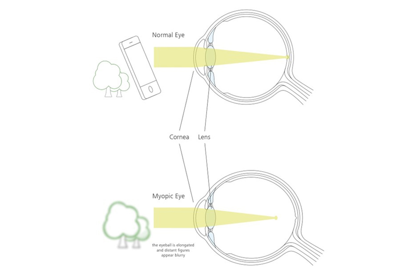 If the eyeball is elongated, light entering the eye reaches its point of focus in front of the retina.