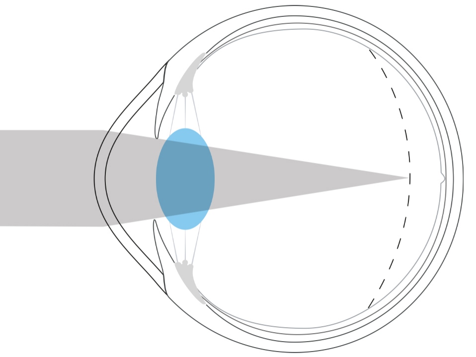 近視眼睛示意圖：顯示光線聚焦在視網膜前方。